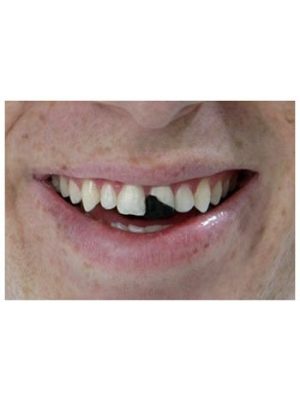 Dente Quebrado Lóide Luxo Os Debilóides Adulto Dente Quebrado Lóide Luxo Os Debilóides Adulto