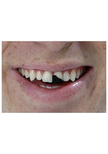 Dente Quebrado Lóide Luxo Os Debilóides Adulto Dente Quebrado Lóide Luxo Os Debilóides Adulto
